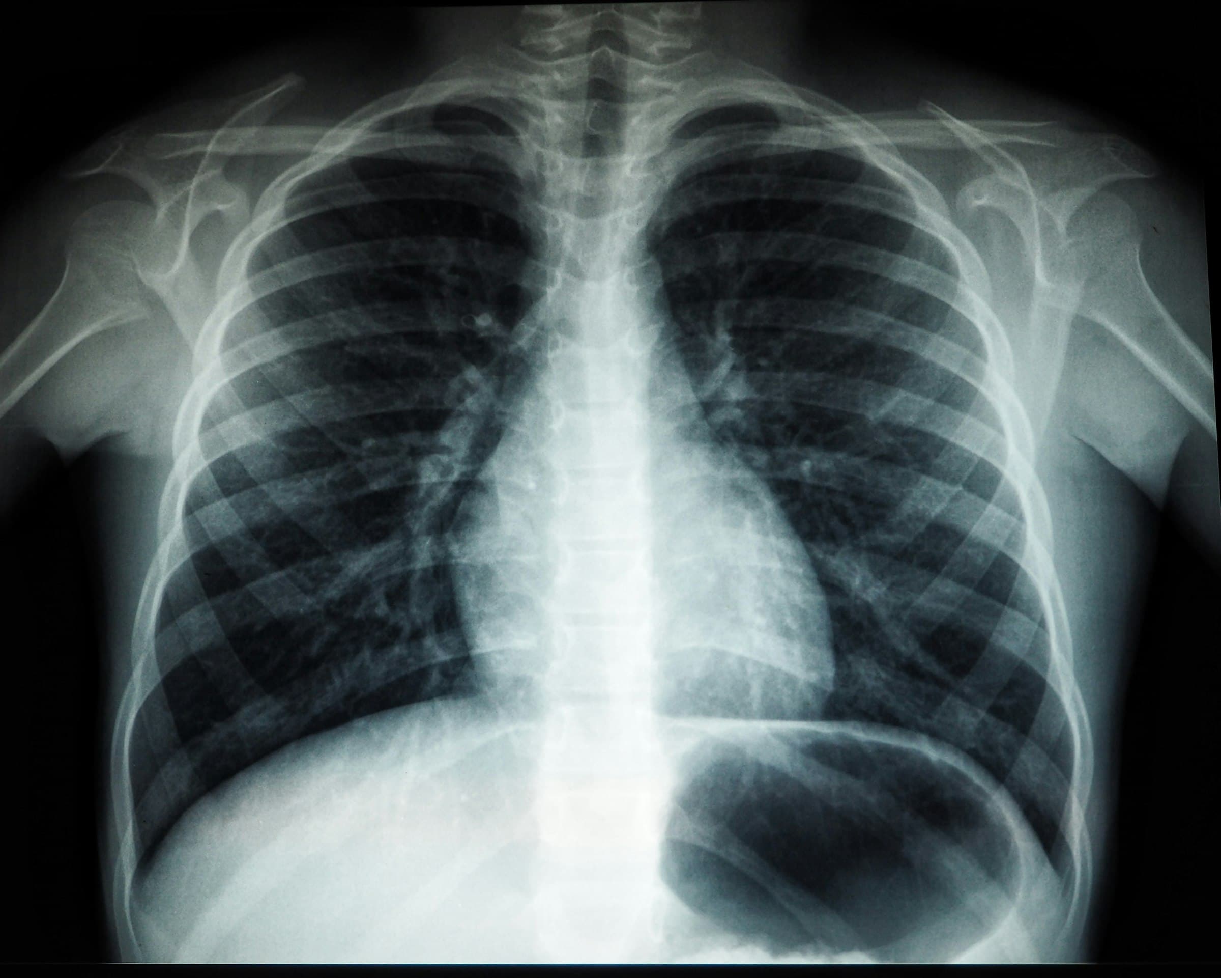 A chest X-ray, ribs, spine and lungs glowing blue-white against black